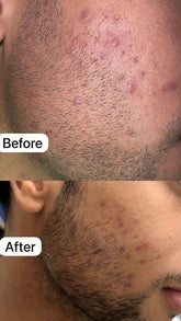 Acne Control - 2 % Salicylic acid