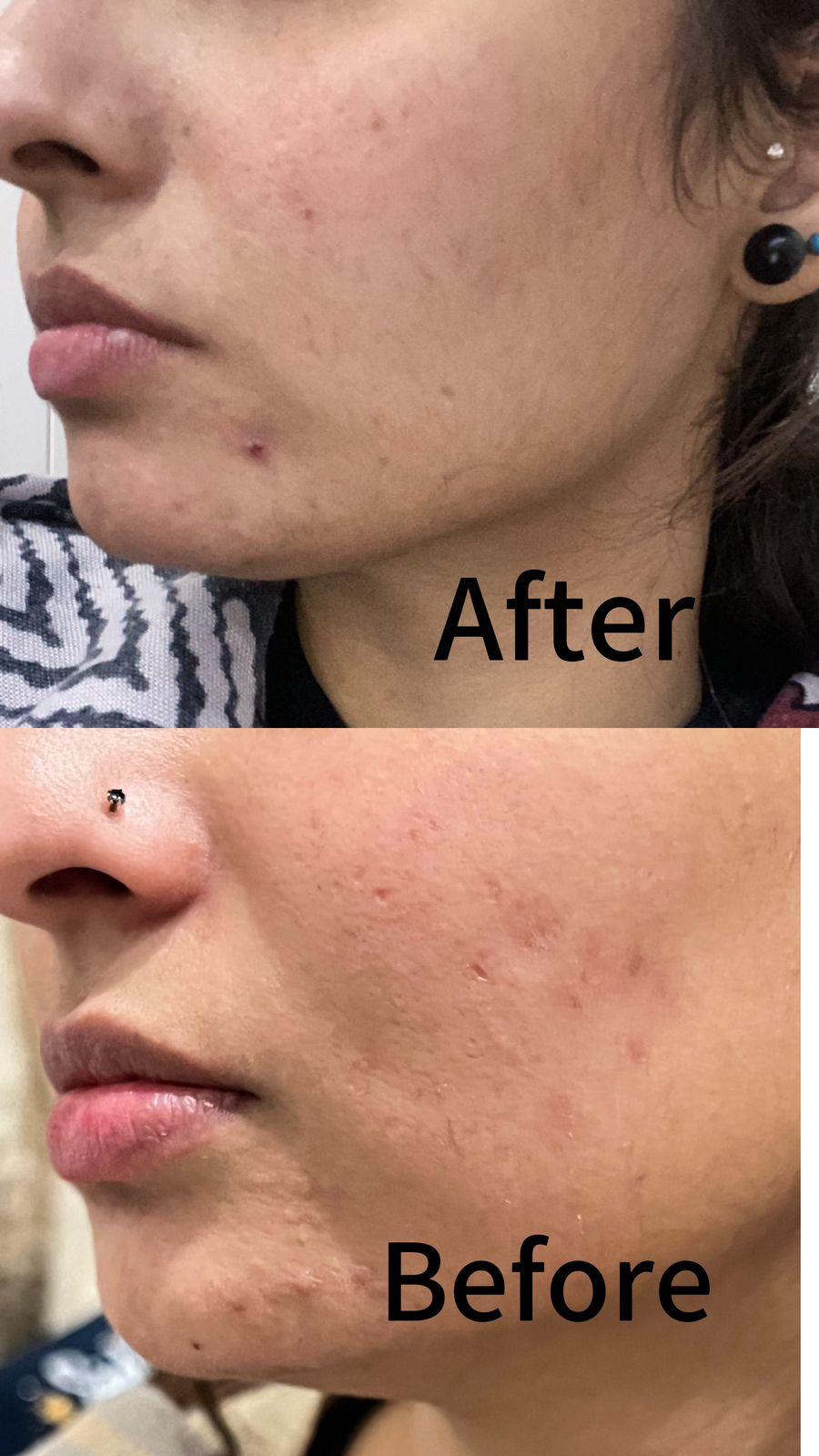 Acne Control - 2 % Salicylic acid