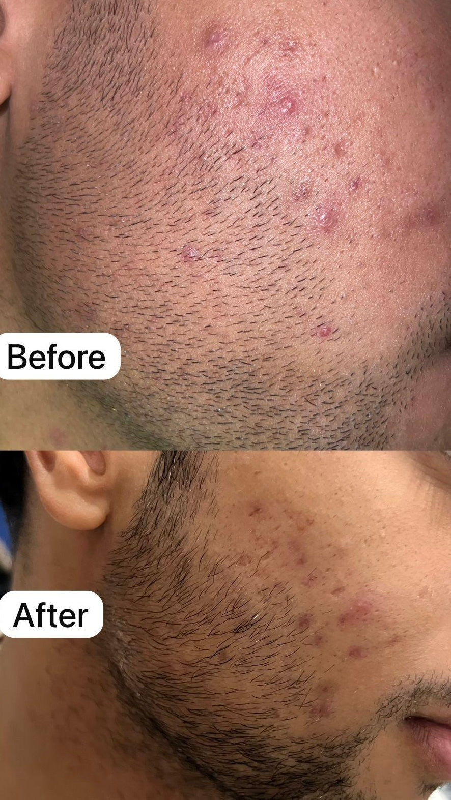 Acne Control - 2 % Salicylic acid
